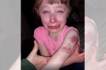 bite marks, Wisconsin girl, 10 year old special needs child brutally bitten on arm while returning home in school bus, Special needs child