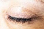 Eyelash Dandruff breaking, Eyelash Dandruff updates, all about eyelash dandruff, Conjunctivitis