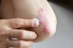 Skin disorders health problems, Skin disorders articles, five common skin disorders and their symptoms, Allergies