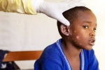 Monkeypox Outbreak new, Mpox, is monkeypox outbreak coming to india, State governments