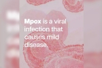 mpox news, mpox symptoms, mpox emergency again, Tamil nadu government