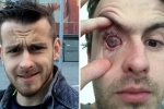 parasites in eyes, parasites eat man’s eye, contact lens wearers beware man goes blind after parasites eat man s eye as he wore lenses in shower, Cornea