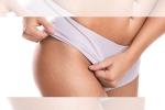 health and fitness, new white stretch marks, difference between red and white stretch marks explained and it s natural to have them, Stretch marks