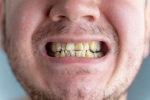 Nicotine stains irreversible, Nicotine stains research, are nicotine stains on your teeth irreversible, Recession
