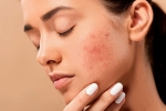 pimples, pimples, 10 ways to get rid of pimples at home, Unsc