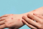 Monkeypox latest updates, Monkeypox updates, study says that the symptoms of monkeypox are different from earlier, Monkey
