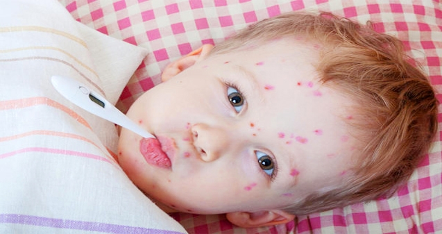 Varicella zoster (chicken pox) vaccine (VZV)