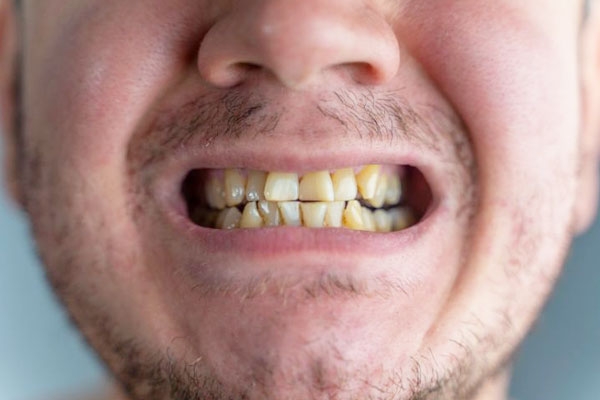 Are nicotine stains on your teeth irreversible?